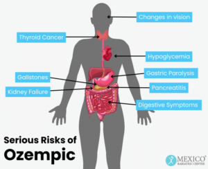 The Potential Side Effects of Using Ozempic for Weight Loss